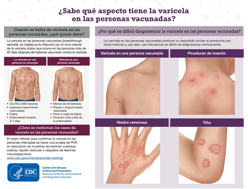 Información sobre la varicela en las personas vacunadas.