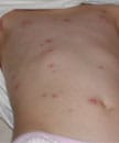 Breakthrough varicella on the abdomen of a vaccinated child.