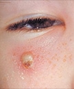Esta es una imagen de una niña con una infección secundaria de la piel en la cara debido a la varicela.