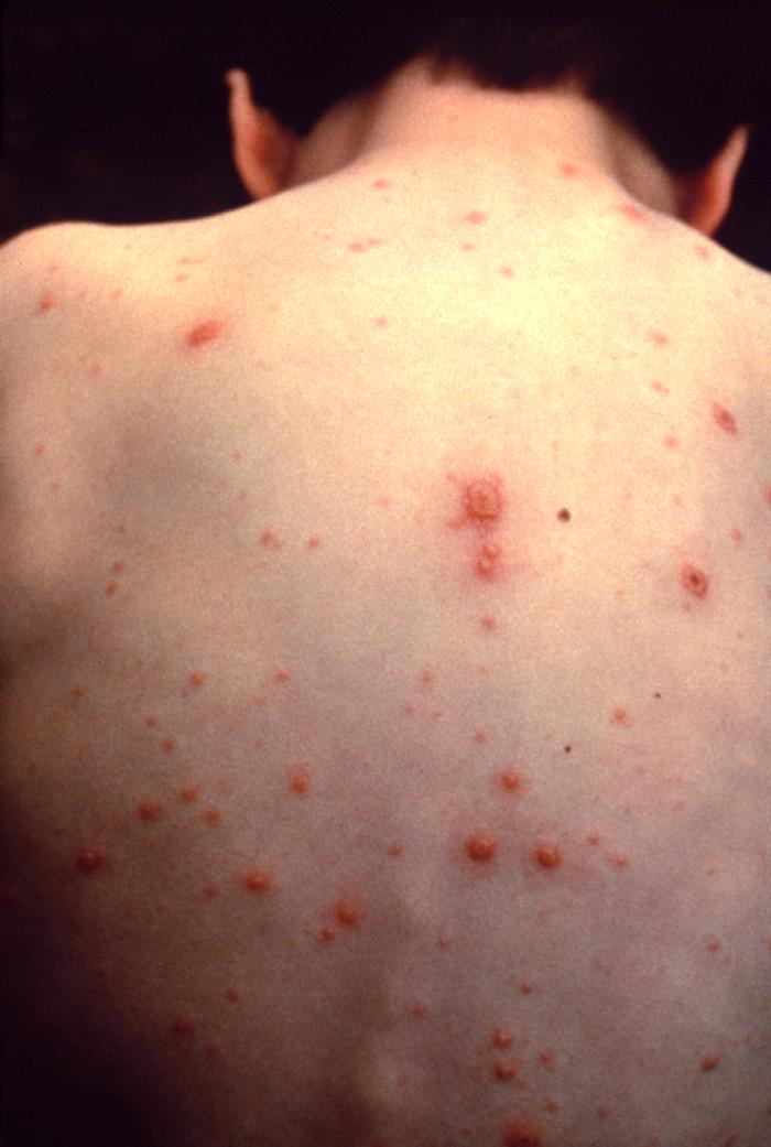 chicken pox pictures in adults