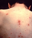 This child presented with the characteristic pancorporeal varicella, or chickenpox lesions.
