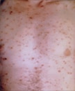 This patient with chickenpox developed lesions on the skin of his chest and torso.