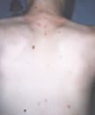 This child presented with the characteristic pancorporeal varicella, or chickenpox lesions.