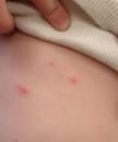 Close-up of skin with several red dots caused by breakthrough varicella.