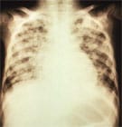 水痘によって引き起こされる肺炎のX線。