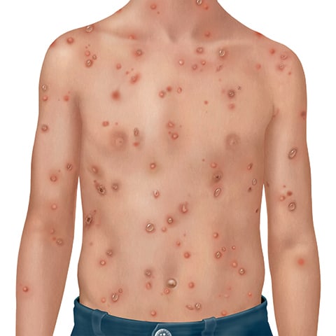 Illustration of varicella rash.