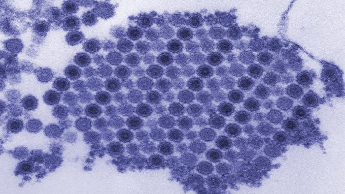 Electron microscopic image of chikungunya virus
