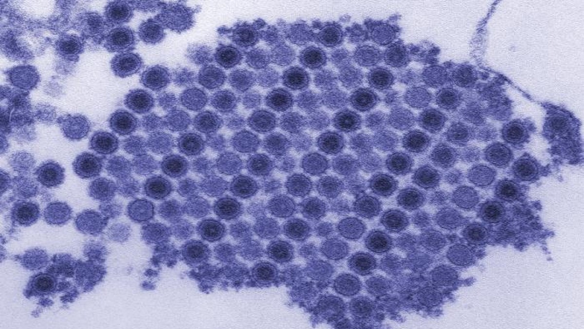 Electron microscopic image of chikungunya virus