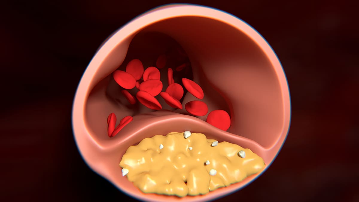 LDL and HDL Cholesterol and Triglycerides