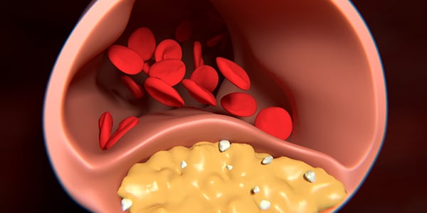 LDL and HDL Cholesterol and Triglycerides