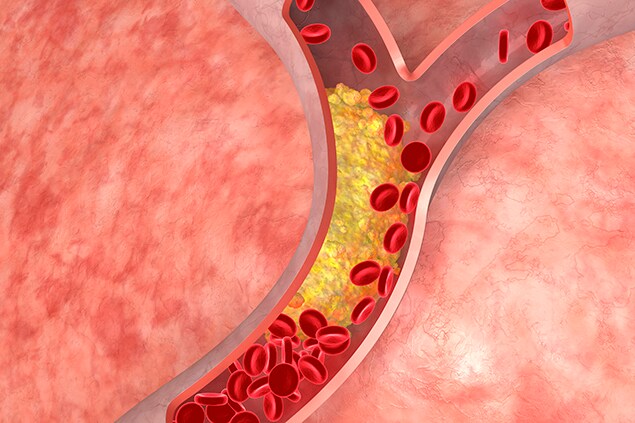 Cholesterol in the arteries.