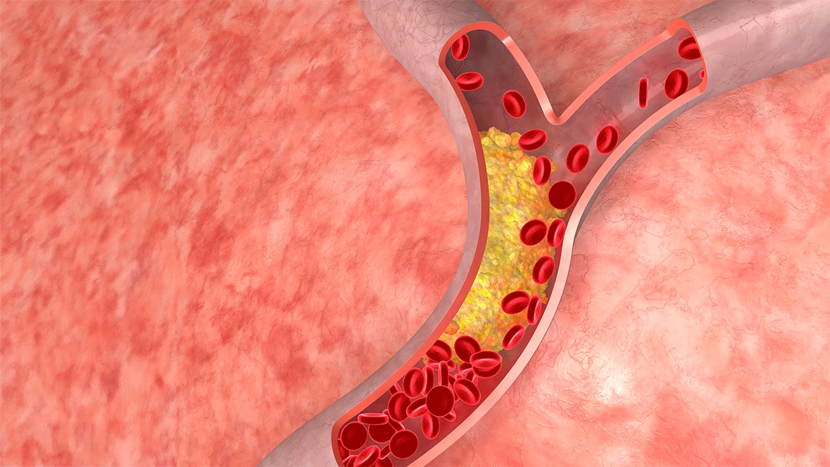 Cholesterol build up in arteries.