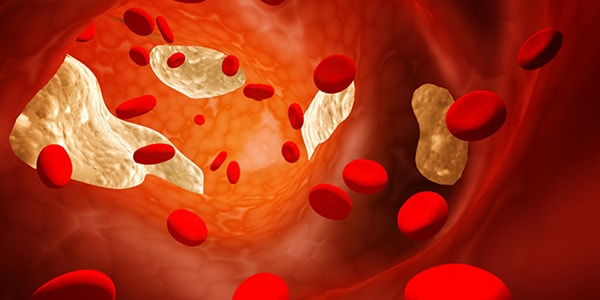high cholesterol and how to lower it naturally