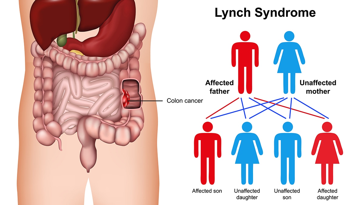Lynch syndrome disease explained with an exposed colon and a pedigree
