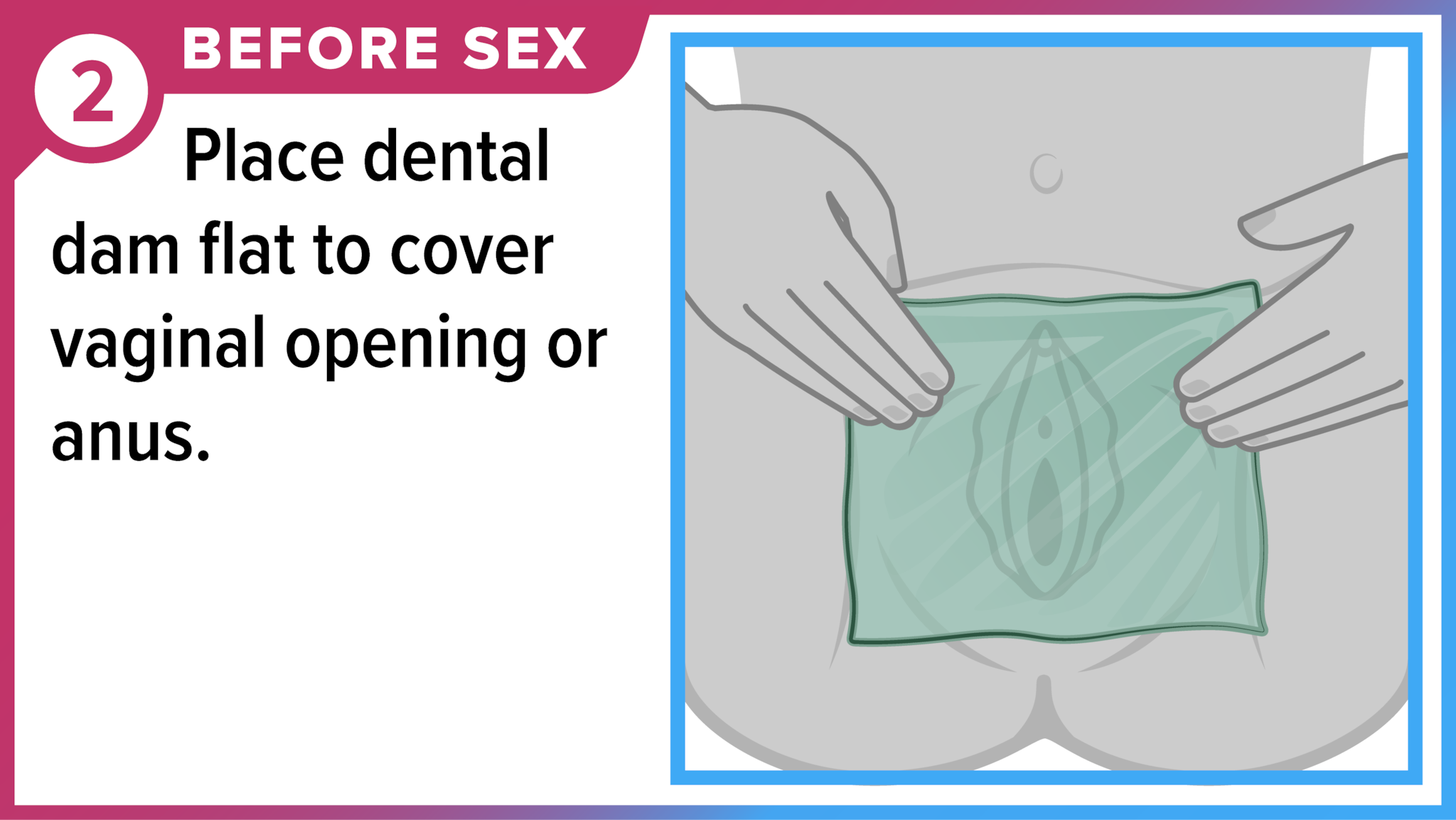 Hands holding dental dam over vulva. Before sex - Place dental dam flat to cover vaginal opening or anus.