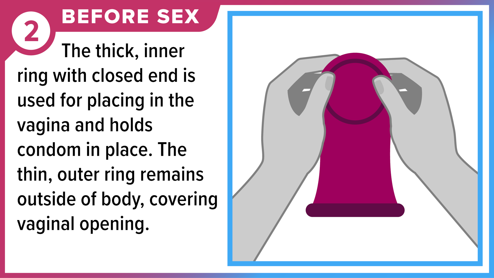 Hands holding female condom at the thick, inner ring. Before sex - The thick, inner ring with closed end is used for placing in the vagina and holds condom in place. The thin, outer ring remains outside of body, covering vaginal opening.