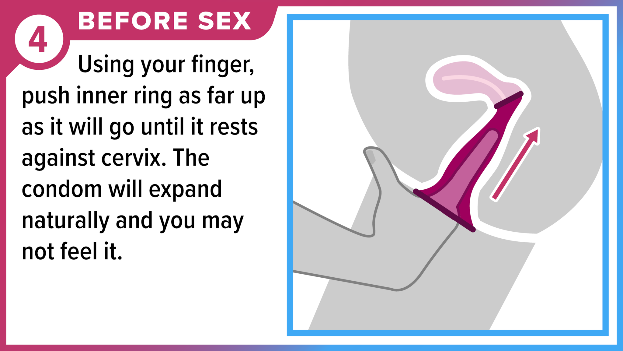Finger inserting female condom into vagina. Before sex - Using your finger, push inner ring as far up as it will go until it rests against cervix. The condom will expand naturally, and you may not feel it.