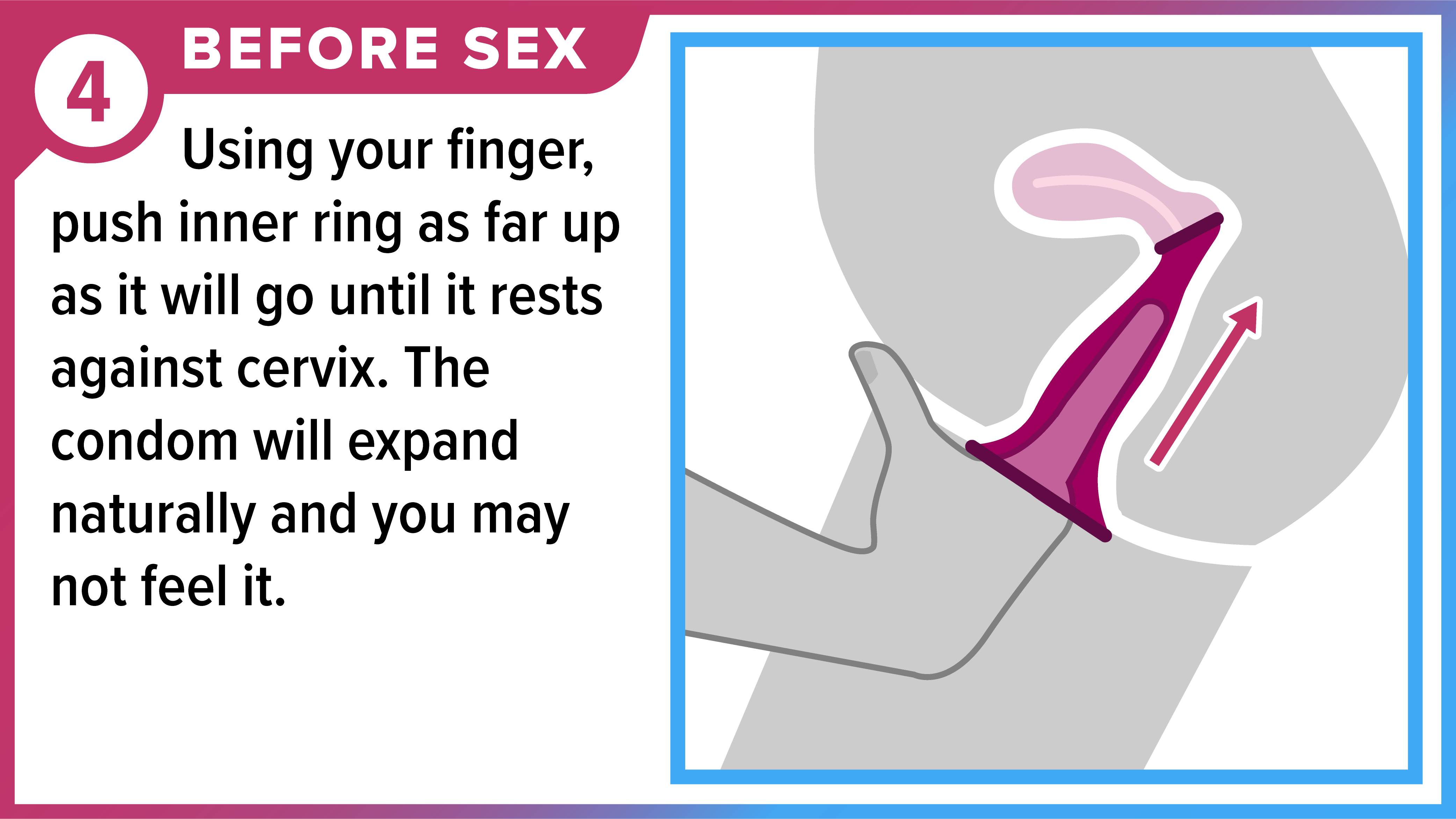 How To Use An Internal Condom Condom Use CDC How To Use An Internal Condom Condom Use CDC