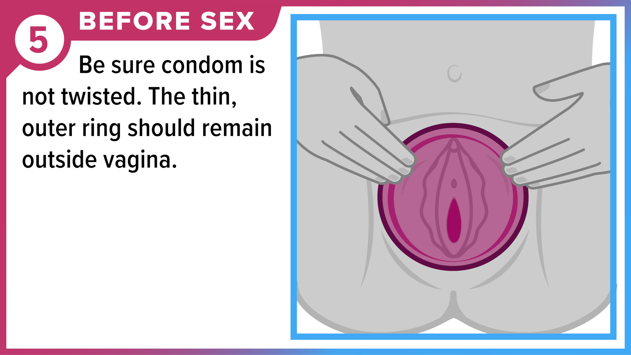 Hands positioning female condom in place to cover vulva. Before sex - Be sure condom is not twisted. The thin, outer ring should remain outside vagina.