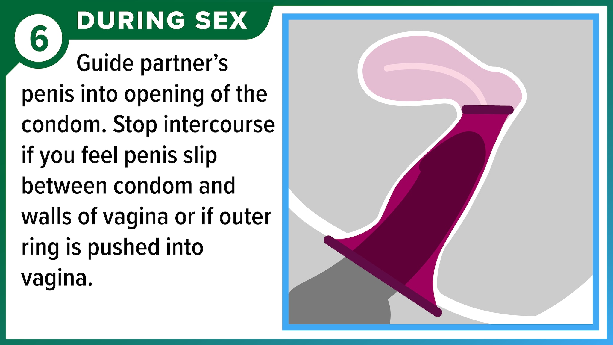 Female condom in place with penis inserted into vagina. During sex - Guide partner's penis into opening of the condom. Stop intercourse if you feel penis slip between condom and walls of vagina or if outer ring is pushed into vagina.