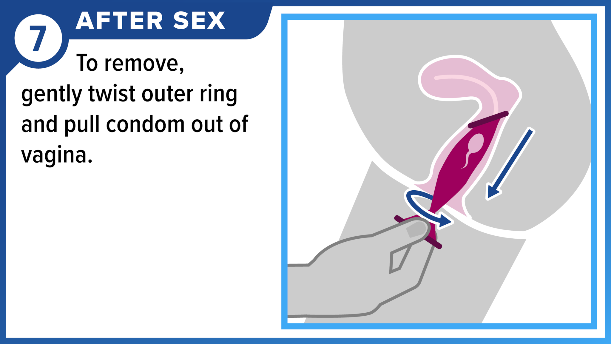 Hand removing female condom. After sex - To remove, gently twist outer ring and pull condom out of vagina.