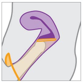 Female condom in place with penis inserted into vagina.