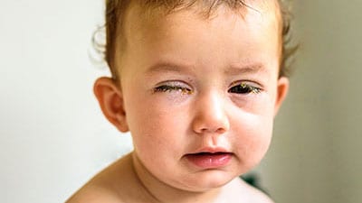 Baby showing symptoms of pink eye like crusting of eyelids.