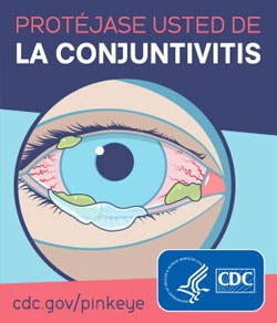 Ilustración de un ojo rojo y lloroso que muestra síntomas de conjuntivitis, incluida la secreción.