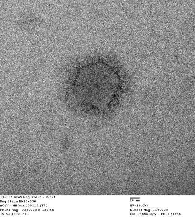 Negative stain electron microscopy shows a novel coronavirus particle with club-shaped surface projections surrounding the periphery of the particle, a characteristic feature of coronaviruses.