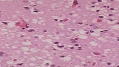A microscope image showing sponge-like holes in the brain tissue of a patient with Creutzfeldt-Jakob Disease.