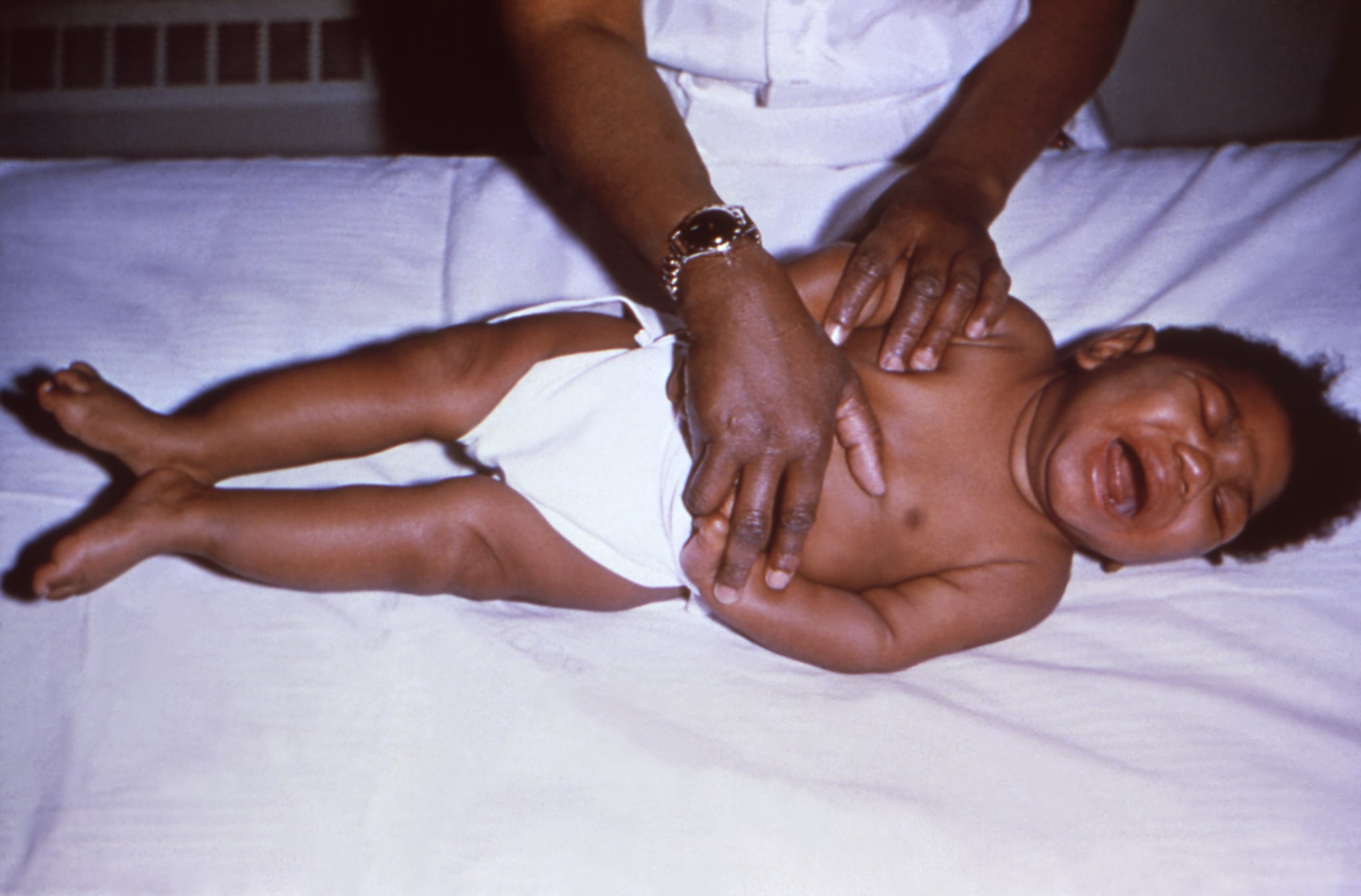 Infant born with congenital CMV showing signs of severe microcephaly and lower limb spasticity. Source: CDC Public Health Image Library.