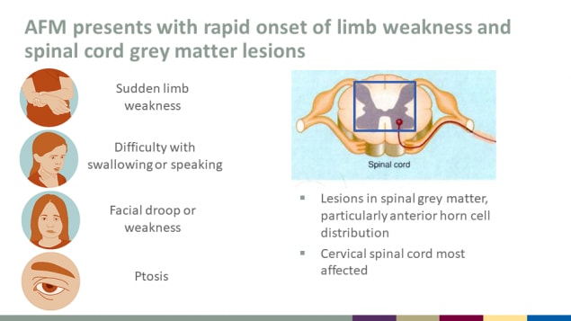 AFM presents with rapid onset of limb weakness and spinal cord grey matter lesions