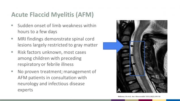 Acute Flaccid Myelitis or AFM, sudden onset of limb weakness within hours to a few days, risk factors unknown.
