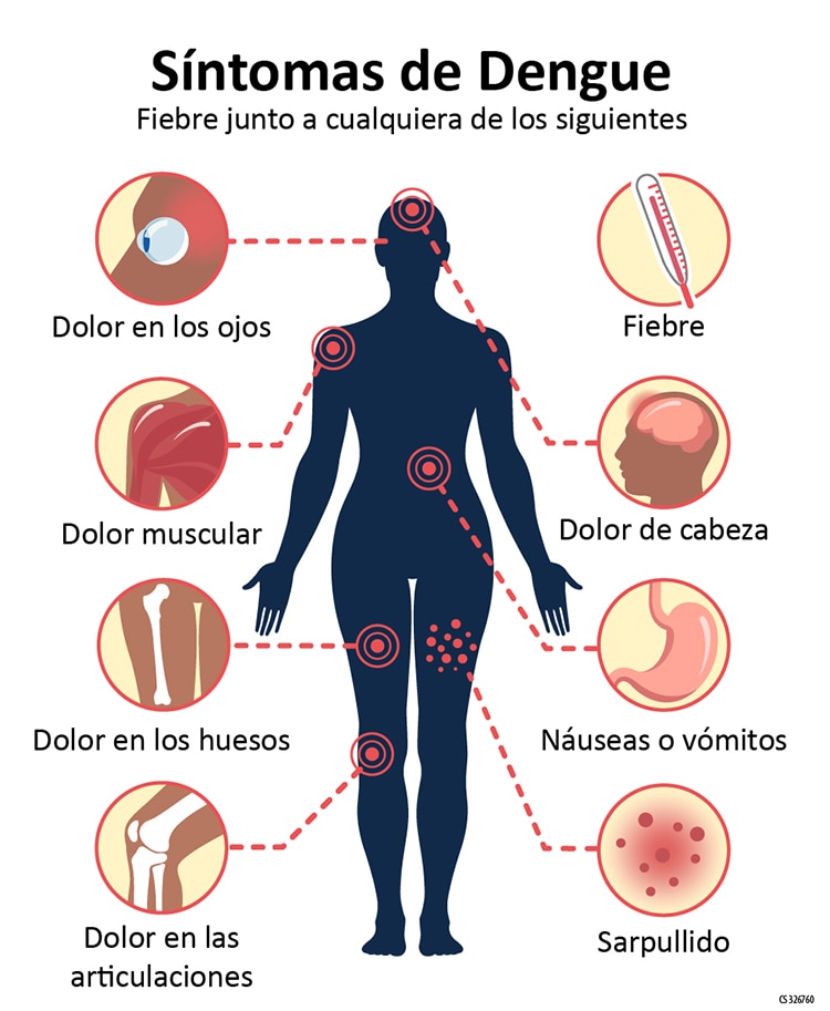 El gráfico del cuerpo humano que muestra el síntoma más común de dengue es fiebre con cualquiera de los siguientes: dolor ocular, dolor de cabeza, dolor muscular, erupción cutánea, dolor óseo, náuseas / vómitos, dolor en las articulaciones