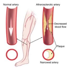 A normal artery is shown on the left with no blockage. The right artery shows how it's been narrowed by plaque (atherosclerosis), causing decreased blood flow, and PAD.