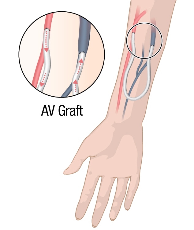 Dialysis access through an arteriovenous (AV) graft.