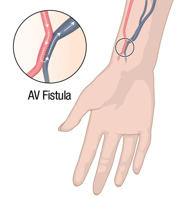 Dialysis access through an arteriovenous (AV) fistula joins a vein and an artery.