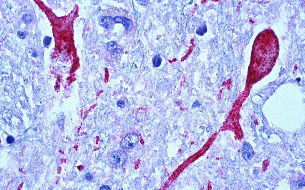 Photomicrograph of brain tissue from a West Nile virus encephalitis patient.
