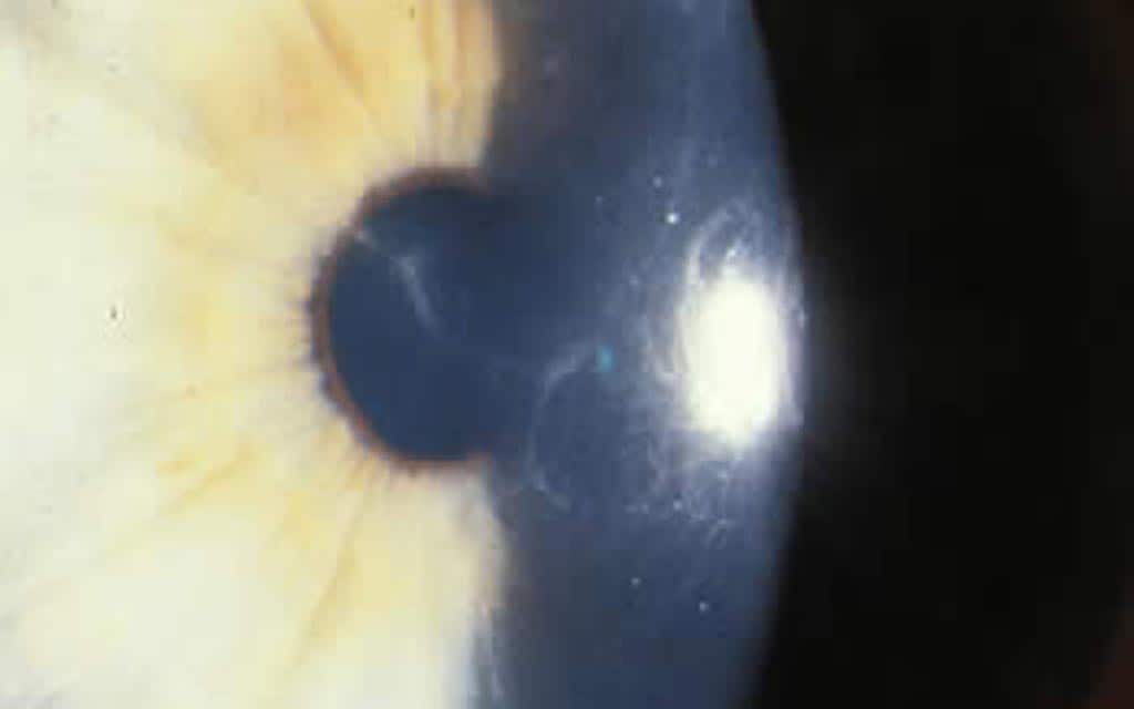 Microscopic image of an eye infected with AK.