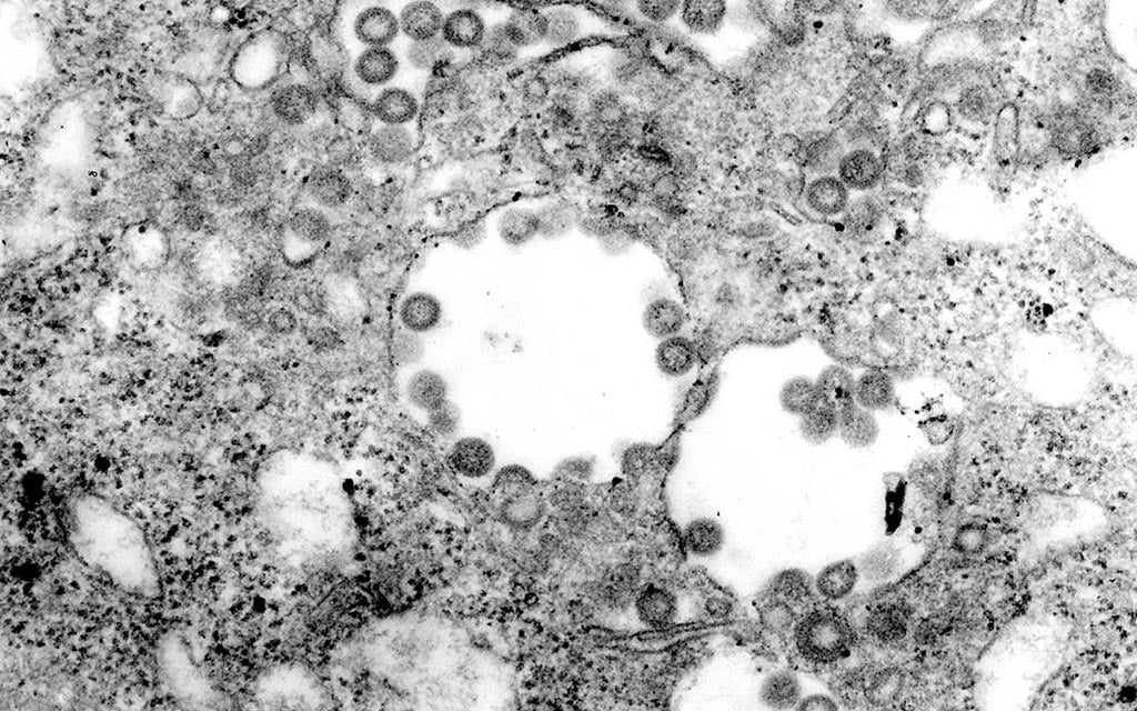 This electron micrograph shows a tissue that has been infected with the Rift Valley fever (RVF) virus at high magnification.