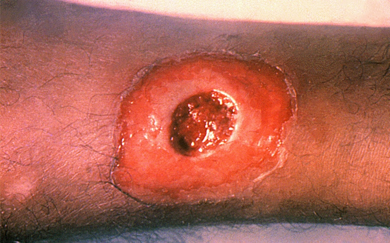 Lesión de la piel en una pierna, causada por difteria.
