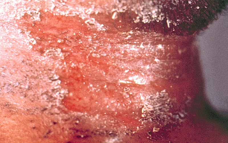 Diphtheria skin lesion on the neck.