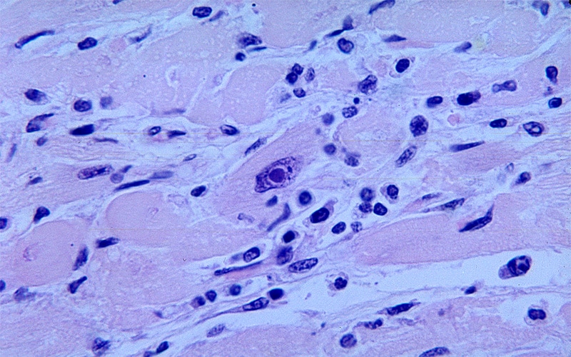 Micrograph revealing an intranuclear inclusion body in a heart section from a patient with diphtheria-related myocarditis.