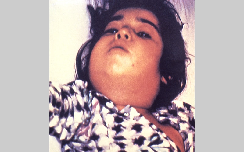 Niño con difteria mostrando un cuello hinchado característico, a veces llamado "cuello de toro".
