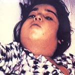 Un niño con el cuello hinchado debido a infección de difteria