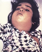 Un niño con el cuello hinchado debido a infección de difteria.