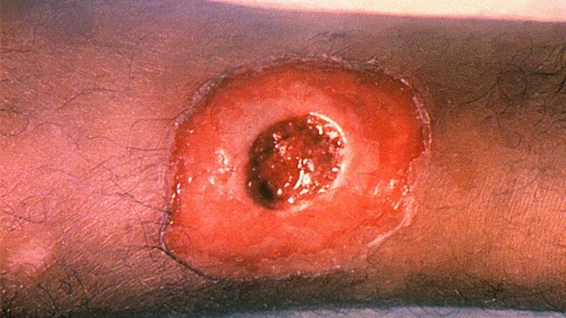 A lesion on the leg caused by cutaneous diphtheria.