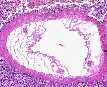 Figure A: Transverse section through the body wall of <em>Bolbosoma</em> sp. in an intestinal biopsy specimen, stained with H&E. Image taken at 100x magnification. Cetaceans are the normal definitive hosts for <em>Bolbosoma</em> spp., and the rare human infections are thought to be a result of eating undercooked fish, which are paratenic hosts for <em>Bolbosoma</em> spp.
