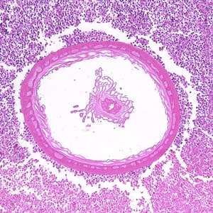 Figure C: Transverse section through the body wall of <em>Bolbosoma sp</em>. in an intestinal biopsy specimen, stained with H&E. Image taken at 100x magnification. In this image, a portion of the reproductive system is visible within the pseudocoelom.