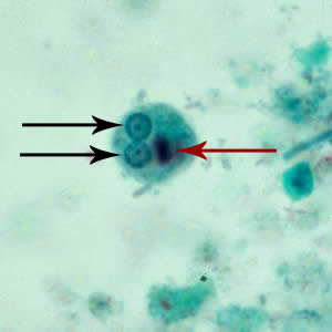 Figure D: Cyst of <em>E. histolytica/E. dispar</em> stained with trichrome. Two nuclei are visible in the focal plane (black arrows), and the cyst contains a chromatoid body with typically blunted ends (red arrow).